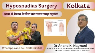 Hypospadias I Kolkata  वयस्क अधोमूत्रमार्गता  Hypospadias Surgery in India 🙂 Urethroplasty Review [upl. by Oznol476]