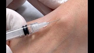 Petra Ganglion Wrist Cyst Aspiration [upl. by Attenaej]