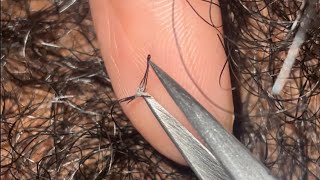 Ingrown and Compound Hair Extractions😍 [upl. by Imerej331]