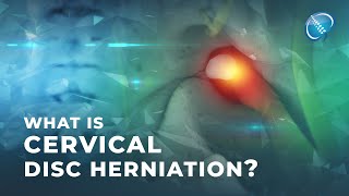 What is Cervical Disc Herniation  Herniated Disc [upl. by Rolando]