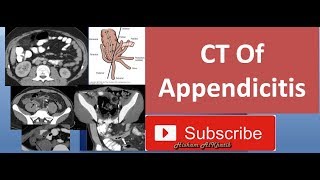 CT Of Appendicitis [upl. by Marrilee968]