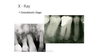 Bone Diseases 2 [upl. by Melborn]