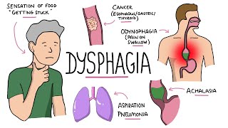 Dysphagia  Oropharyngeal amp Esophageal Dysphagia CausesDifferential Diagnosis Signs Treatment [upl. by Lamrouex]