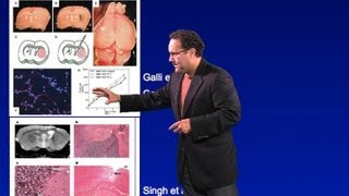 Alfredo QuiñonesHinojosa Johns Hopkins Part 1 Brain Tumors [upl. by Notxap]