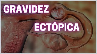 Gravidez ectópica  Fisiologia Humana [upl. by Aniez]