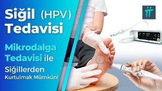 Siğil Tedavisi HPV Tedavisi Siğil Kökü Nasıl Çıkarılır I TuranampTuran [upl. by Gustafsson]