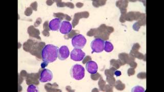 Acute Myeloblastic Leukemia M1 [upl. by Clintock]