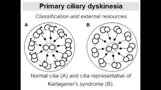 Kartageners Syndrome dynein arm defect affecting cilia [upl. by Silrak]