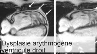 Dysplasie arythmogène du ventricule droit  causes symptômes et méthodes de traitement [upl. by Nellek]