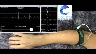 Needle EMG demonstration [upl. by Romulus786]