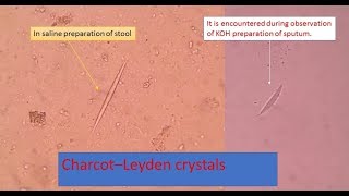 Charcot Leyden crystals Inroduction appearnace and clinical significance [upl. by Sirotek]