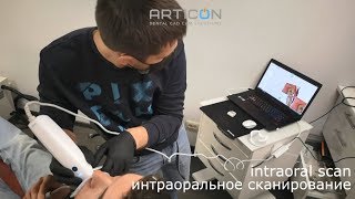 Medit i500 bitesplint окклюзионная шина [upl. by Gussie626]