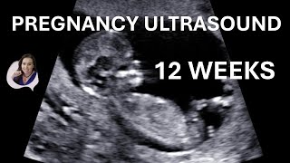 12 weeks pregnancy ultrasound video [upl. by Downall956]