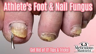 Reverse Nail Fungus Caused by Athletes Feet [upl. by Elidad587]