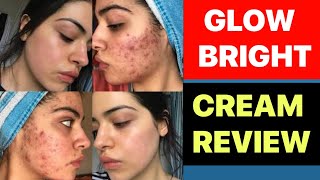 melasma treatment cream in hindi  acne removal cream  pimples ka cream [upl. by Htiekal]