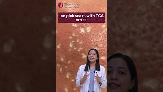 Ice Pick Scars Treatment  Ice Pick Scars TCA Cross  Acne Scar Treatment in Noida  Skinlogics [upl. by Oicnerual637]