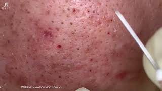 Big Cystic Acne Blackheads Extraction Blackheads amp Milia Whiteheads Removal Pimple Popping [upl. by Aland495]