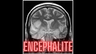 ENCEPHALITE [upl. by Oidacra498]