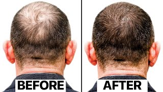 The Truth Behind This New Hair Loss Treatment  Exosomes [upl. by Ahsieker]