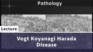 VOGT KOYANAGI HARADA DISEASE [upl. by Nitsua]