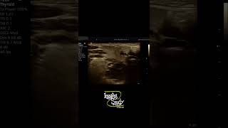 Normal Palatine Tonsil Ultrasound imaging shorts anatomy medical ultrasound [upl. by Ynor]