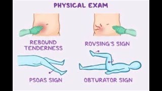 Why would a Retrocaecal Appendicitis cause Pain when the Thigh is Lifted Psoas and Obturator Sign [upl. by Merwyn]