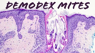 Demodex Mites under the microscope Demodex folliculorum amp Demodex brevis demodex mites on face [upl. by Ecinnej90]