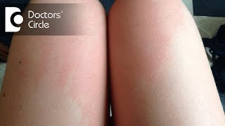 Causes of Itchy Bruise on Thigh and how to manage it  Dr Amee Daxini [upl. by Niamart960]