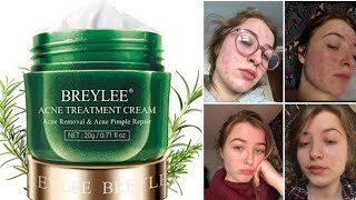 Breylee Acne Treatment Cream Review Bangla [upl. by Enyamart]