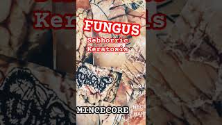 FUNGUS  SEBHORRIC KERATOSIS Mincecore Lovers VORACIOUS PRURITUS IN NECROTIC HARMONY EP [upl. by Aiblis]