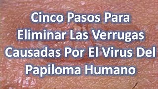 Remedios Caseros Para Eliminar Las Verrugas Causadas Por El Virus Del Papiloma Humano [upl. by Nehepts]