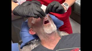 CRNA Anesthesia Nasal Intubation POV Dental Office [upl. by Aerised]