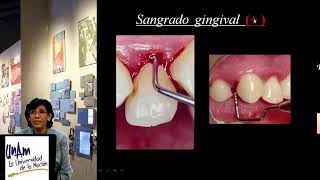 Nuevo sistema de clasificación para la periodontitis [upl. by Karena]