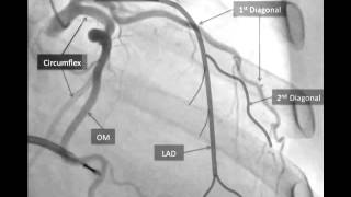 Coronary Dissection [upl. by Gladwin]