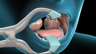 Tonsillectomy amp Adenoidectomy  Nucleus Health [upl. by Elynad]