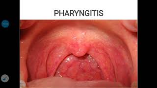 Pharyngitis [upl. by Hisbe747]