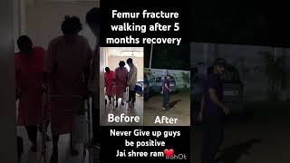 Femur fracture Recovery femur femurbone doctor nevergiveup staystrong motivation tibia bones [upl. by Conan]