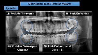 Clasificación de Winter  Pell y Gregory para Terceros Molares Cordales [upl. by Ruhtra]