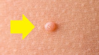 how to get rid of molluscum contagiosum fast [upl. by Ariel]