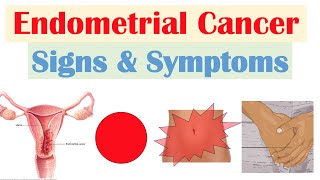 Endometrial Cancer Signs amp Symptoms amp Why They Occur [upl. by Yenruogis]