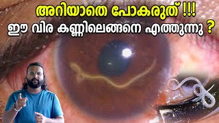 നമ്മുടെ കണ്ണിന് പണി തരുന്ന പാരസൈറ്റുകൾ Eye Parasites eye worms [upl. by Llerihs454]