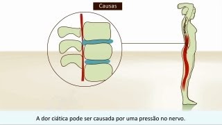 Ciática  O que é a dor ciática e como você pode tratála [upl. by Romalda]