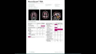 Can brain MRI identify beginning signs of FrontoTemporal Dementia [upl. by Nitsirk]