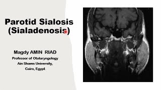 Parotid Sialosis Salivary Sialoadenosis [upl. by Launce]