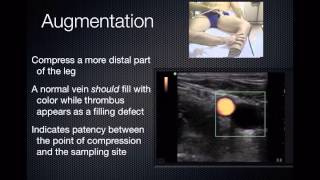 DVT Ultrasound [upl. by Low]