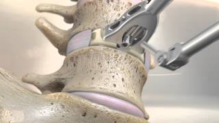 STALIF M™ MIDLINE II Surgical Technique Animation  Anterior Lumbar Interbody Fusion [upl. by Anaerb41]