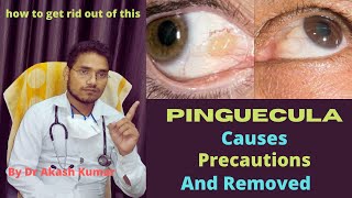 Pinguecula  Pinguecula को कैसे हटाएं  how to remove of pinguecula [upl. by Aretina664]