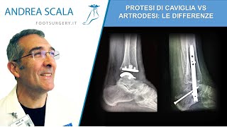 Artrodesi vs Protesi di caviglia  le differenze  Caviglia bloccata Dott Andrea Scala [upl. by Enyaz901]