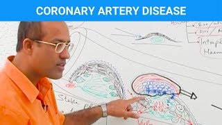 Coronary Artery Disease  Ischemic Heart Disease  Angina🫀 [upl. by Pincince]