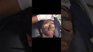 BEST ANTI ACNE TREATMENTCARBONLASERPEEL DESIGNERDOCDERMATOLOGIST acne shorts viral [upl. by Laen437]